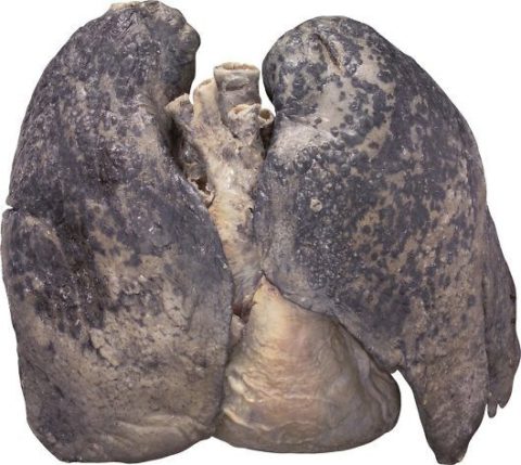 Вот такие изменения в лёгких курящего наблюдают патологоанатомы