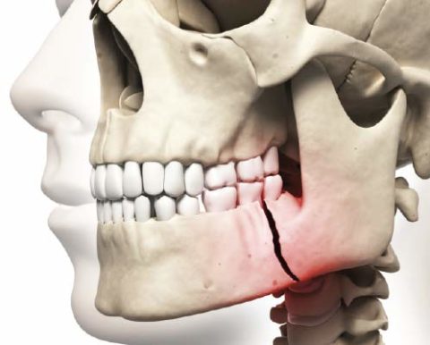 Перелом челюсти без смещения наименее опасны, т. к. отломки кости не меняют своего физиологического положения.