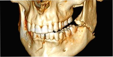 Перелом челюсти может произойти в трех (и более) местах.