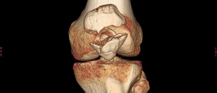 Перелом коленного сустава