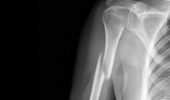 Перелом кости в среднем отделе часто осложняется надрывом мышечной ткани.