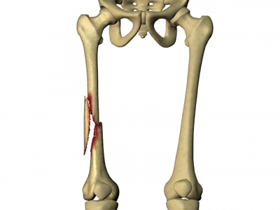 Перелом тела бедренной кости