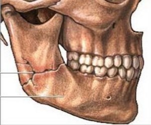 Перелом ветви челюсти может стать следствием остеомиелита.