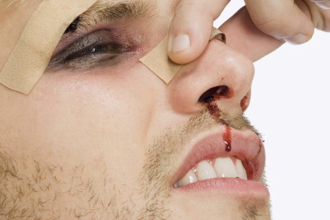 Переломы носа диагностируются преимущественно у представителей мужского пола от 15 до 40 лет