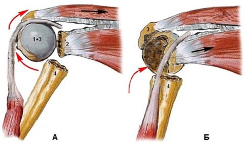 Переломы в верхней (проксимальной) зоне плеча