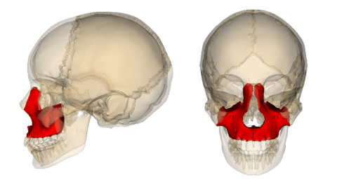 Переломы верхней челюсти являются часто сложными сочетанными травмами и чреваты различными осложнениями.