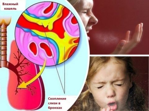 Первым проявлением обструктивного бронхита у детей является сильный малопродуктивный кашель с вязкой мокротой