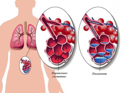 Пневмония – воспаление легочной ткани с поражением альвеол