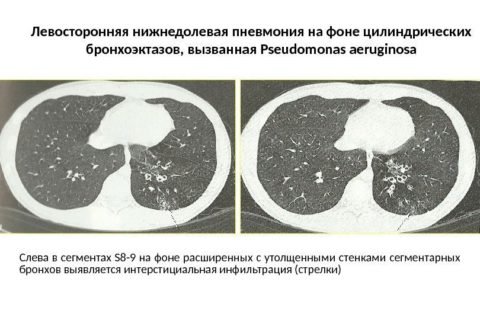 Пневмония на КТ снимке
