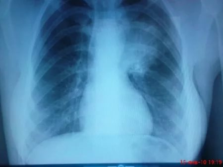 Пневмония на рентгене.