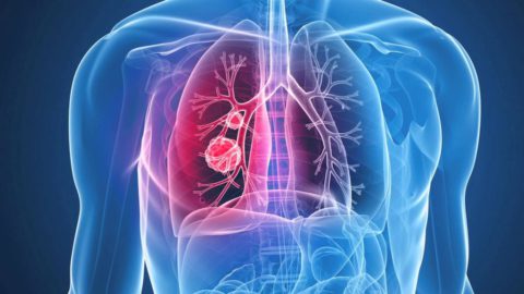 Пневмония поражает лёгочные ткани
