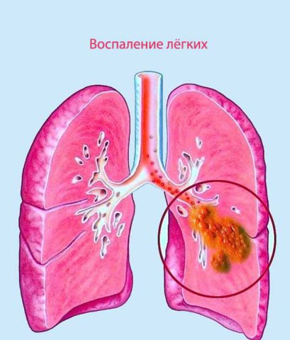 Пневмония, вызванная стафилококком – очень опасное заболевание
