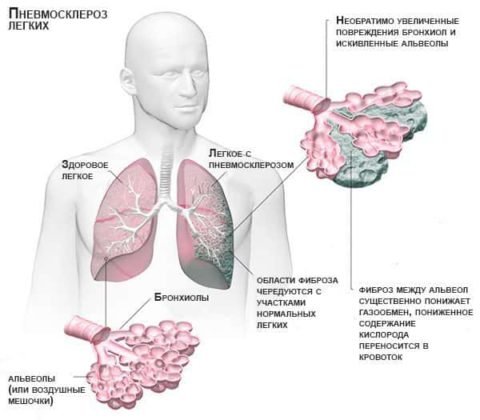 Пневмосклероз легких