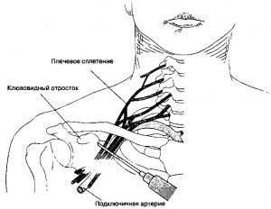 Блокада сплетения плечевого сустава