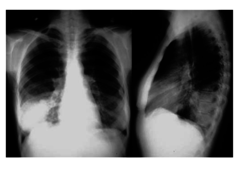 Такая пневмония проявляется на рентгене так же, как и классическая