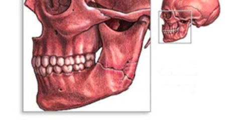 Повреждение костных тканей челюсти может стать следствием заболеваний, например, остеомиелита.