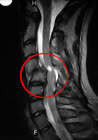 Повреждение спинного мозга в шейном отделе позвоночника