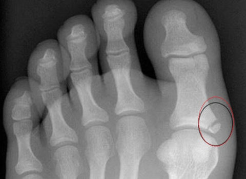 Поврежденная кость на рентгенографическом снимке