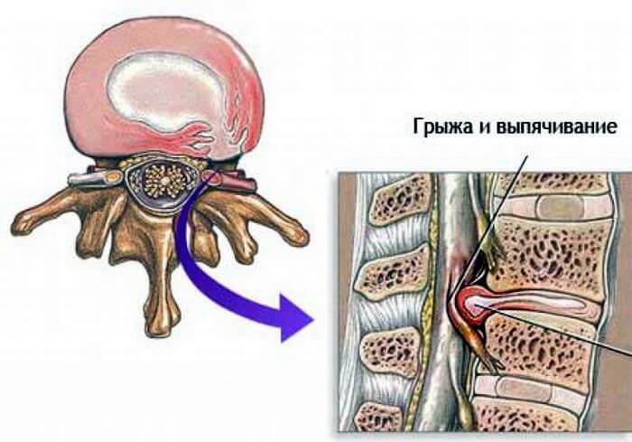 что такое остеохондроз пояснично крестцового отдела позвоночника