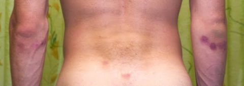 Появление синяков и кровоизлияний под кожным покровом из-за полученных ударов в область спины