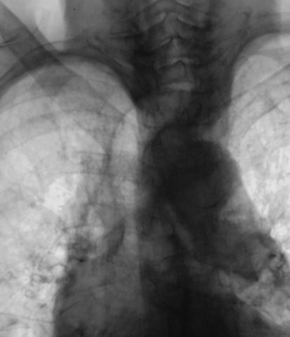 Правосторонняя среднедолевая пневмония на рентгенограмме