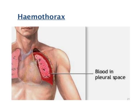 При гемотораксе также делают пункцию и откачивают из плевры кровь.