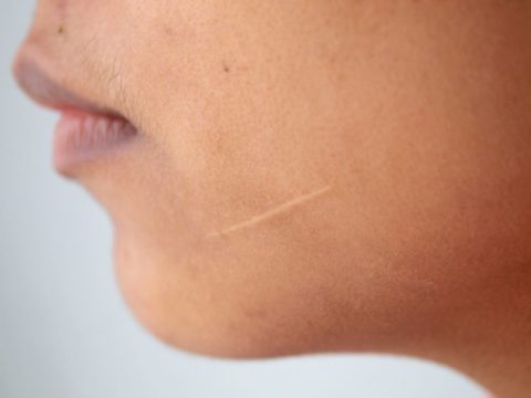 При глубоких ранах после укусов домашних питомцев либо даже при мелких царапинах при склонности к образованию рубцов, могут появляться уплотнения на коже.