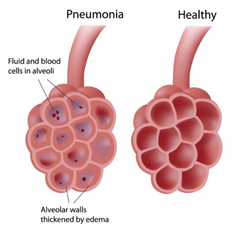 При очаговой пневмонии поражаются отдельные альвеолы и бронхиолы