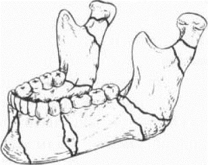 При осколочном переломе челюсти могут образовываться один (или несколько) отдельных мелких фрагментов.