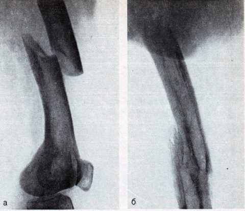 При переломах бедренной кости может происходить смещение отломков относительно друг друга.
