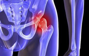 Симптомы при переломе шейки бедра: основные признаки травмы и ее осложнений