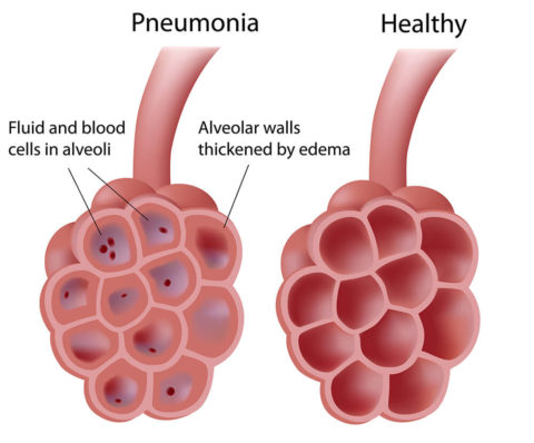 При пневмонии способность легких насыщать кровь кислородом снижается