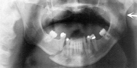 При полном переломе челюсти происходит полное разрушение костных тканей, часто с отрывом их от основы.