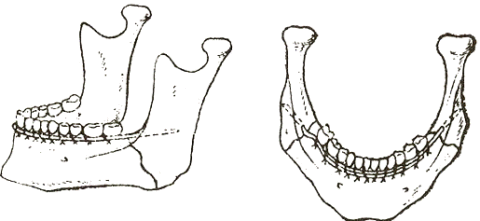 При помощи спиц происходит фиексация отломков костей нижней челюсти.