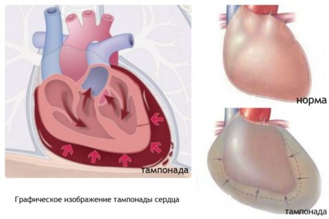 При проведении тампонады сердца может возникнуть перикардит.