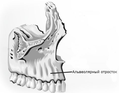 При сильной травме могут возникать переломы альвеолярных отростков челюстей.