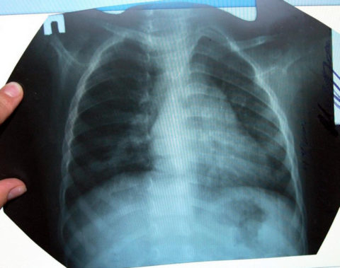 Признаки пневмонии на рентгенографии.