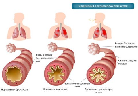 Признаки, предшествующие приступу астмы