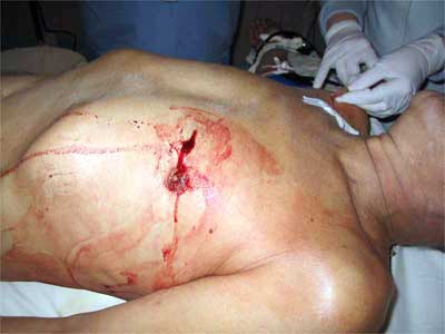 Проникающее ранение в грудную клетку (фото)