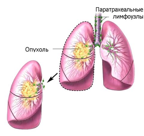 Рак легких чаще имеет центральное расположение и развивается из тканей бронхов или альвеол
