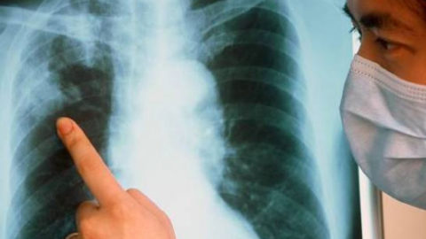 Раннее выявление туберкулеза – одна из задач здравоохранения
