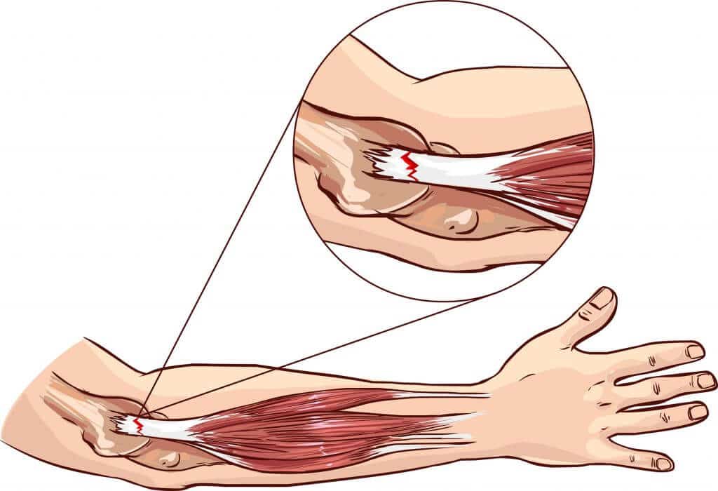 Разрыв мышц в руке
