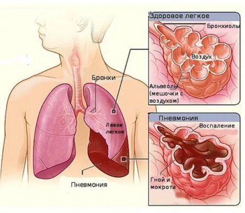 Развитие пневмонии