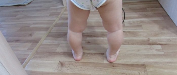 Рекурвация колена у ребенка
