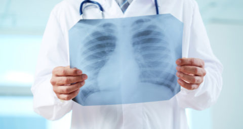 Рентген – наиболее информативный диагностический метод при пневмонии
