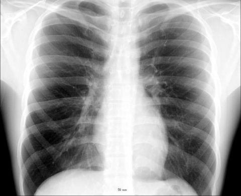 Рентген легких при туберкулезе
