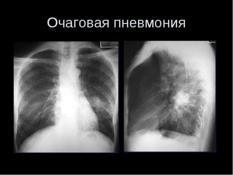 Рентген очаговой пневмонии