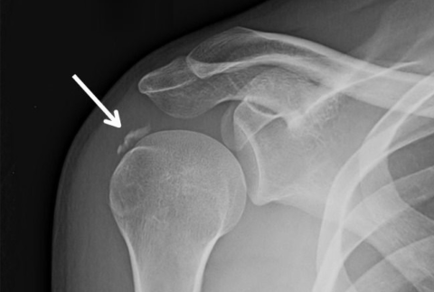 Рентген отрыва большого плечевого бугорка со смещением