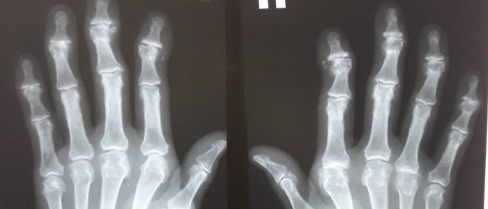 Рентгенография при артрите