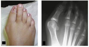 Молоткообразный палец на ноге